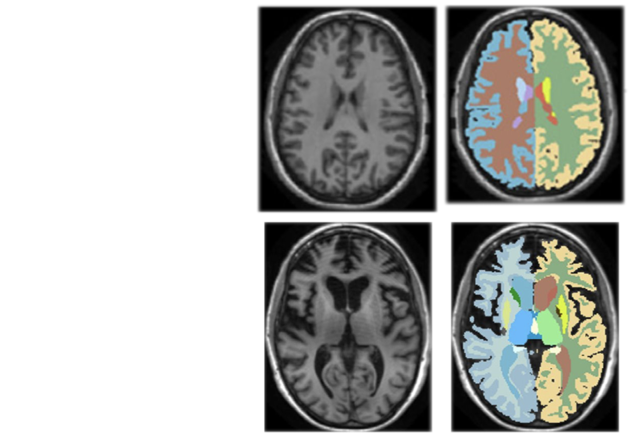 difference-healthy-alzheimer